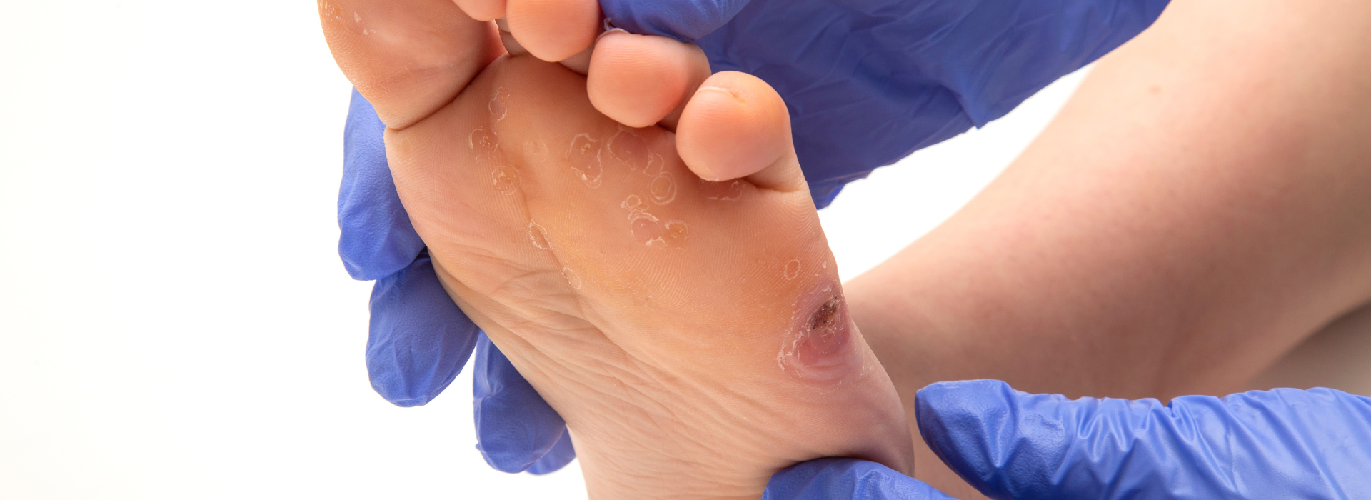 Tratamiento especializado de pie diabético en La Ligua - Prevención de úlceras y cuidado vascular